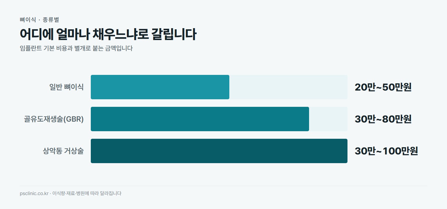 임플란트 뼈이식 종류별 비용 비교. 일반 뼈이식 약 20만~50만원, 골유도재생술 GBR 약 30만~80만원, 상악동 거상술 약 30만~100만원
